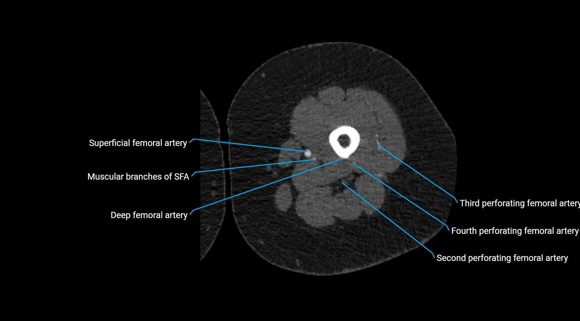 CTA lower limb cross sectional anatomy labelled image _129.webp